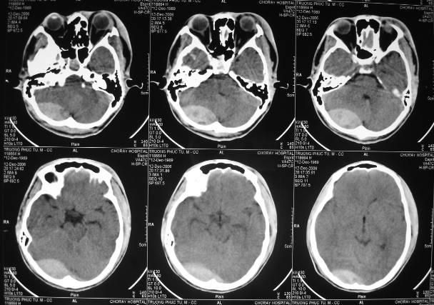 Hình ảnh chụp CT Scan não bộ