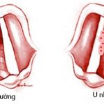 nguyen-nhan-gay-ung-thu-vom-hong-1