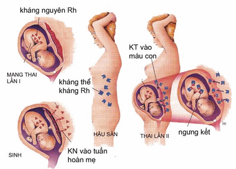 Sự tác động của kháng thể Rh với thai nhi