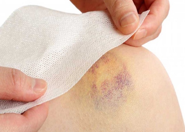 Vết bầm vàng trên da có gây nguy hiểm không?