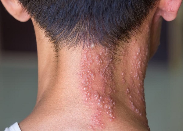 Zona thần kinh gây khó chịu và ảnh hưởng đến sinh hoạt người mắc